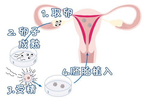 精液分析